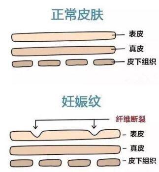 壬辰纹刚开始的图片_男人壬辰纹_怀孕壬辰纹图片