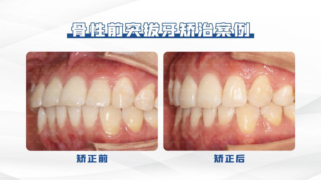 骨性、下巴后缩牙齿矫正，一定要吗？不一定！