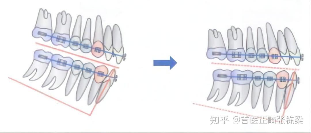 骨性、下巴后缩牙齿矫正，一定要吗？不一定！