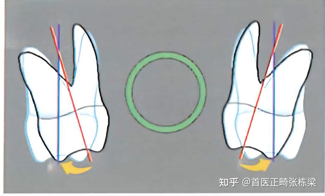 骨性、下巴后缩牙齿矫正，一定要吗？不一定！